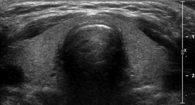 Thyroid Screening Ultrasound Durango Colorado